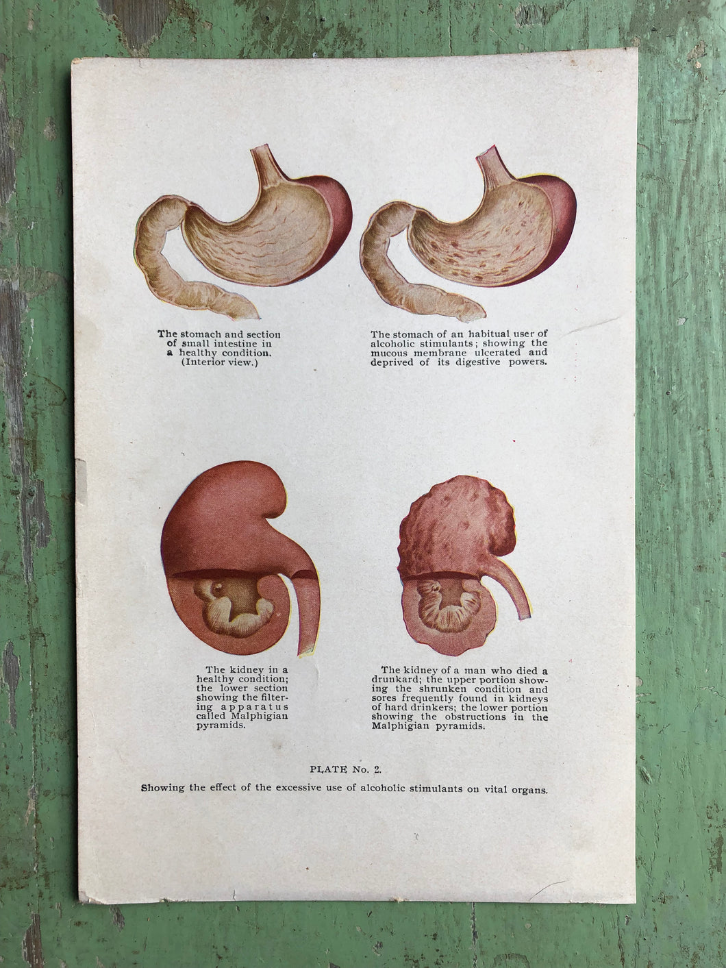 Effects of excessive use of alcohol on the kidneys and stomach. Print from 
