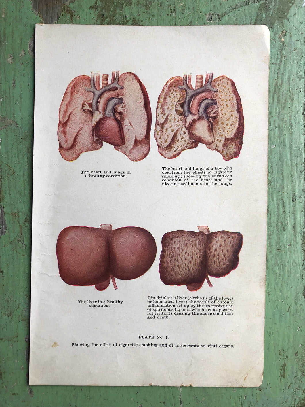Effects of cigarettes and alcohol on the liver and lungs. Print from 