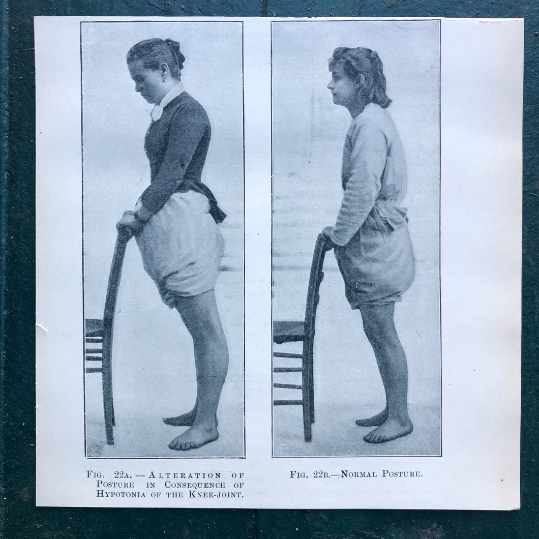 Figs. 22A and 22B. Print from “The Treatment of Tabetic Ataxia by Means of Systematic Exercise” by Dr. H. S. Frenkel