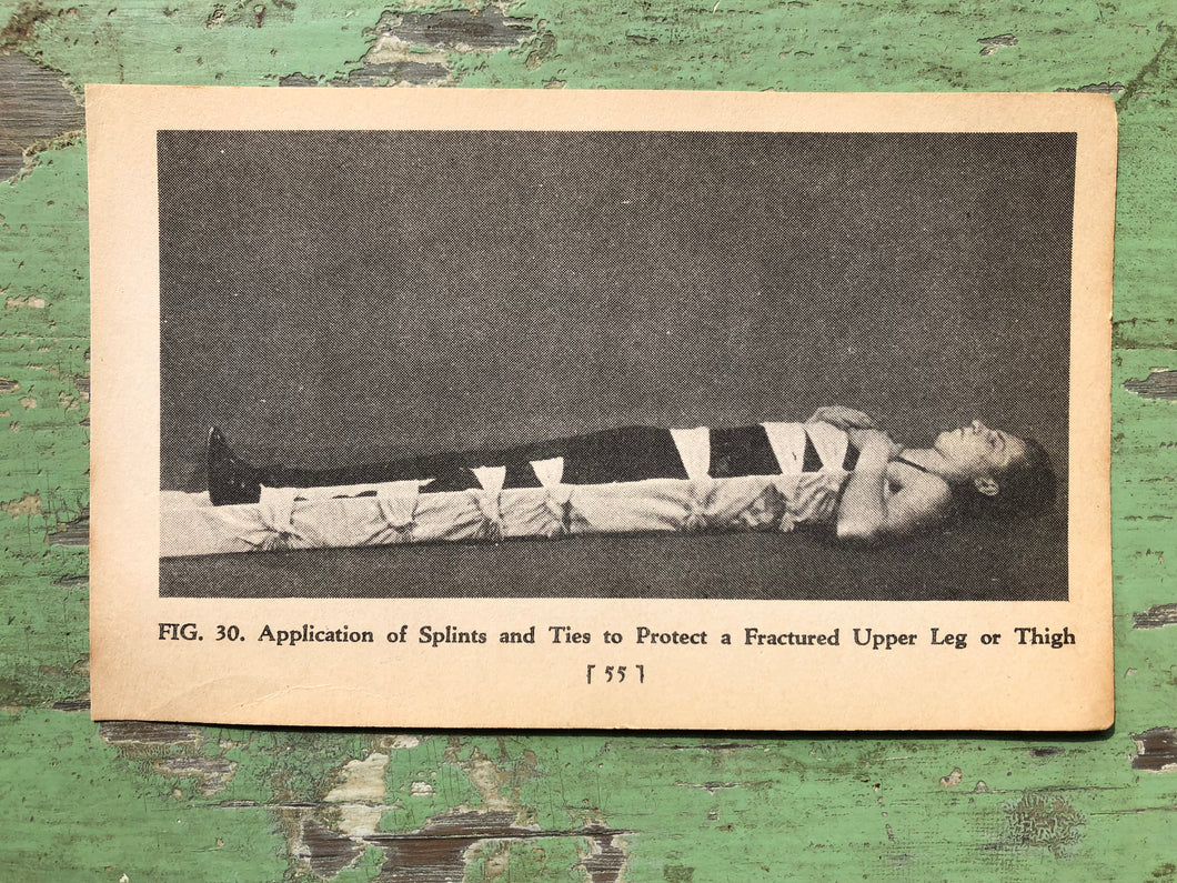 Fig. 30, Print from A Handy Guide to First Aid. by James Carlton Zwetsch