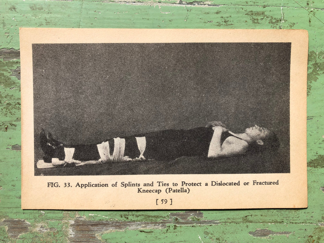 Fig. 33, Print from A Handy Guide to First Aid. by James Carlton Zwetsch